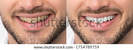 Teeth before and after whitening. Dental care concept Royalty-Free Stock Photo #1754789759
