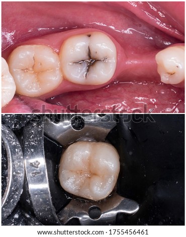 before and after picture of tooth restoration by composite