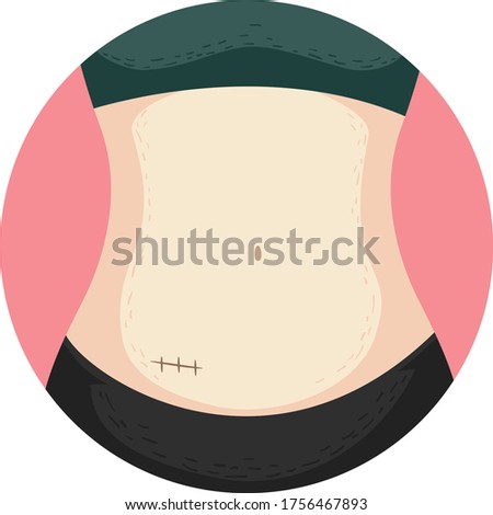 Illustration of a Woman Showing Belly With Stitches From Appendectomy Surgery