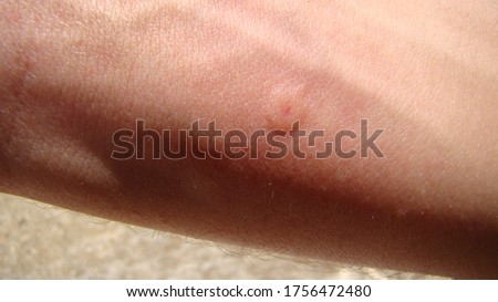 bee : stung by a bee worker
skin allergy , allergic
treatment by honey bee sting
closeup honey bee stinging a hand
insects, insect, animal, wildlife, wild nature, forest, garden
beauty of pollination Royalty-Free Stock Photo #1756472480