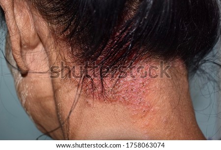 Seborrheic dermatitis or fungal skin infection at the scalp of Southeast Asian, Myanmar adult female patient. Left lateral view. Royalty-Free Stock Photo #1758063074
