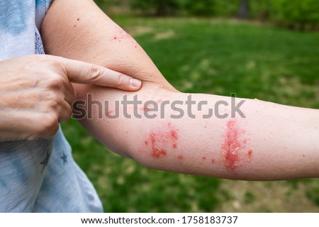 Pointing at itchy poison ivy / poison oak rash and infection with blisters and oozing Royalty-Free Stock Photo #1758183737