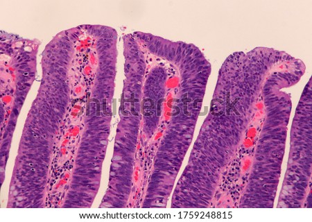 Surface of a colon polyp called a villous adenoma, showing enlarged, dark cell nuclei and loss of mucin. Microscopic view. Royalty-Free Stock Photo #1759248815