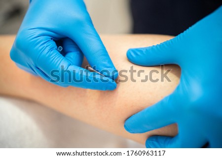 Close-up of a needle and hands of physiotherapist doing a dry needling in a physiotherapy center. Royalty-Free Stock Photo #1760963117