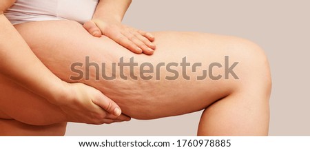Cellulite leg woman pinch. Test fat hips treatment. Over weight liposuction. Remove striae. Royalty-Free Stock Photo #1760978885