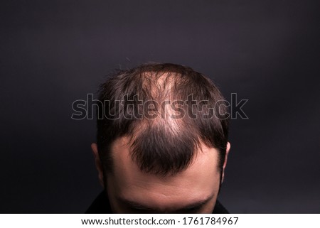 Male head close-up with baldness. Studio black background. Royalty-Free Stock Photo #1761784967