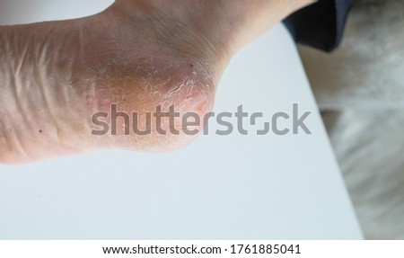 Cracked skin heels  senior man legs