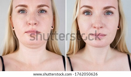 Double chin lift in women. Photos before and after plastic surgery, mentoplasty or facebuilding. Chin fat removal and face contour correction
