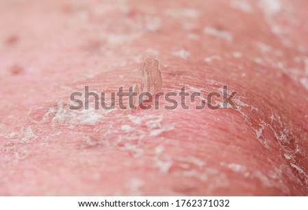 background with the texture of irritated reddened skin with flaking cell scales after sunburn and allergies on the human body