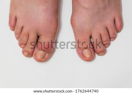 Gout or podagra on the big toe appears as redness and unbearable pain Royalty-Free Stock Photo #1762644740