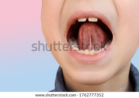 boy, kid performs articulation exercises for mouth, concept of speech disorders, correction, frenum of tongue, methods of correctional developmental exercises Royalty-Free Stock Photo #1762777352
