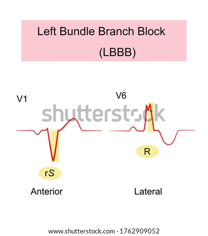 Left Bundle Branch Block (LBBB) of ECG wide QRS complexes  with abnormal  morphology in leads V1 and V6,QRS duration greater than 120 , causes the left ventricle to contract later the right ventricle Royalty-Free Stock Photo #1762909052