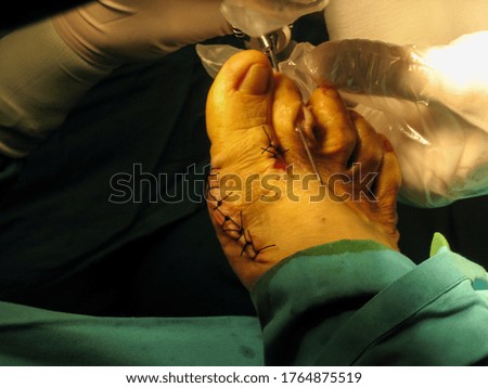hallux valgus foot surgery in the operating room