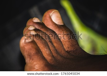 Dark skin man foot - Close-up toenail Fungus - Nail Fungus on Legs of black man. Picture of fingers on the leg. A male corn on his fourth toe from wearing heels too often.