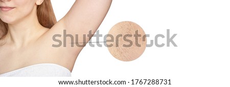 Girl underarm. White woman armpit. Before after epilation collage. Wax depilation result concept. Laser hair removal. sugaring spa procedure. Health care home routine. IPL treatment. Copyspace banner