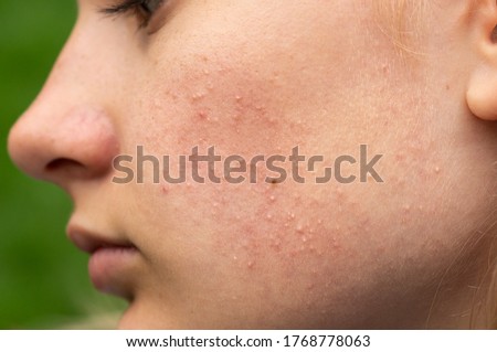 Problematic skin. Acne and red festering pimples on the face of a young girl. Facials for teen girls. Skin care concept.  Royalty-Free Stock Photo #1768778063
