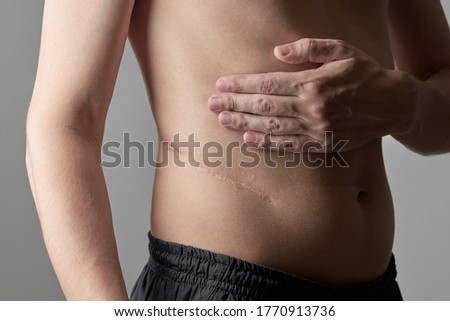 male perosn showing surgery scar after kidney pyelonephritis. after remove kidney operation. caucasian person close up over grey background. Royalty-Free Stock Photo #1770913736
