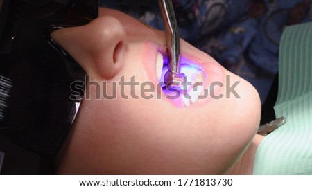 Applying resin based composite filling on tooth and curing it with LED. Young woman at dental clinic. Female dentist with assistant treating cavities in a patient mouth in modern dental office. Royalty-Free Stock Photo #1771813730