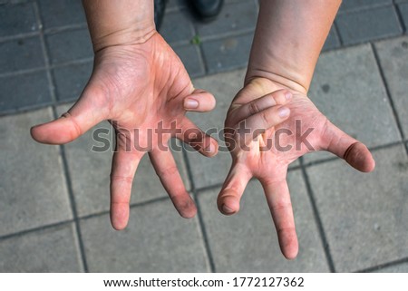 Numbness in the hands of a sick person, locomotor disorder of muscles and tendons
