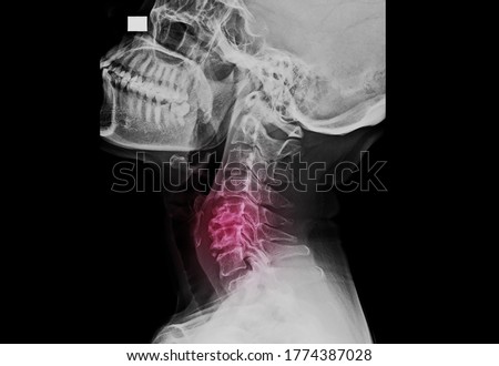 A lateral projection of cervical spine x-ray showing multiple degenerative spondylosis causing neck pain and myelopathy. The patient needs surgical decompression, reconstruction and spinal fusion. Royalty-Free Stock Photo #1774387028