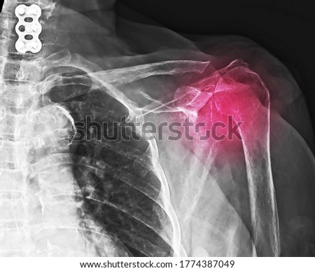 A shoulder x-ray showing superior subluxation of shoulder that caused by massive rotator cuff tear. The patient needs surgical reconstruction and repair of rotator cuff or arthroplasty. Royalty-Free Stock Photo #1774387049