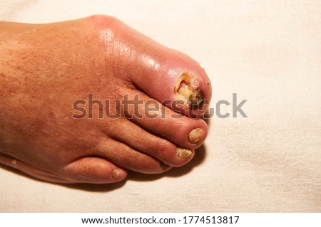 big toe of a diabetic elderly person with sores, necrosis and regeneration of the skin after daily healing after the nail has been removed Royalty-Free Stock Photo #1774513817