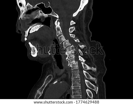 A sagittal view computer tomography or CT scan of cervical spine showing multiple degenerative spondylosis causing neck pain and myelopathy. The patient needs surgical decompression and spinal fusion. Royalty-Free Stock Photo #1774629488