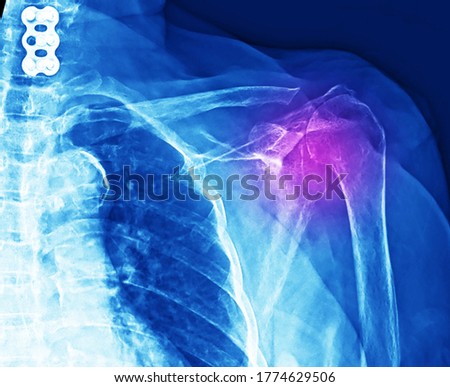 A shoulder x-ray showing superior subluxation of shoulder that caused by massive rotator cuff tear. The patient needs surgical reconstruction and repair of rotator cuff or arthroplasty. Royalty-Free Stock Photo #1774629506