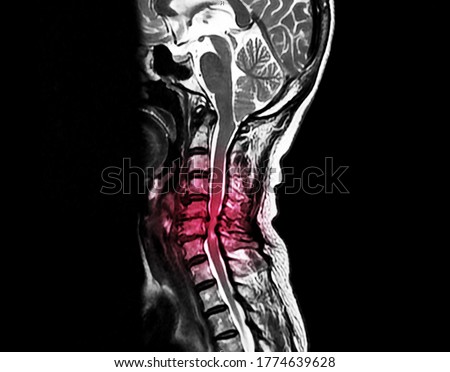 A sagittal view magnetic resonance image or MRI of cervical spine showing severe spinal cord compression that cause neck pain and myelopathy. The patient needs decompression and spinal fusion. Royalty-Free Stock Photo #1774639628