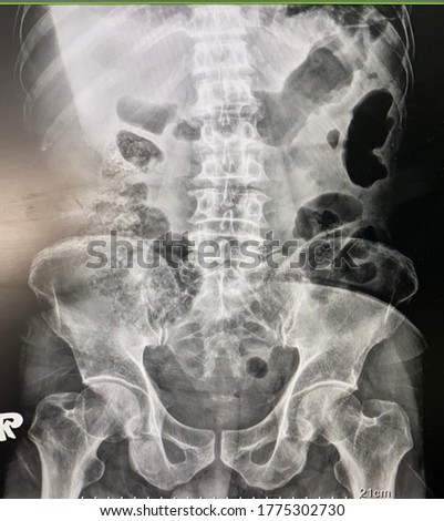 The picture of film x-ray abdomen of patient who have hollow viscus organ perforation,Medical Technology and healthcare concept.