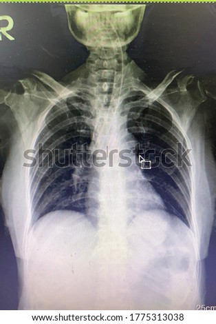 The picture of film chest x-ray  of patient that on one lung endotracheal intubation ,Medical Technology and healthcare concept.