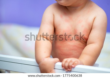 little baby with allergy in crib at home Royalty-Free Stock Photo #1775400638