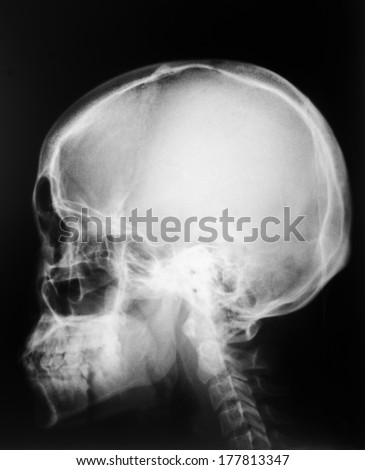 X-ray , Lateral skull