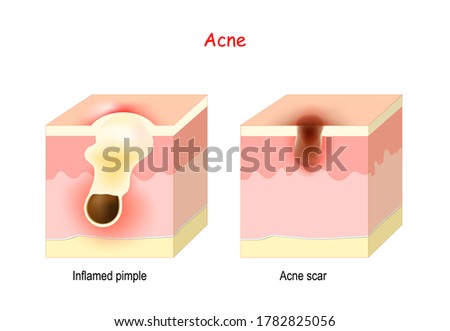 Acne treatment. Cross section of the human skin with Inflamed pimple and Acne scar. 