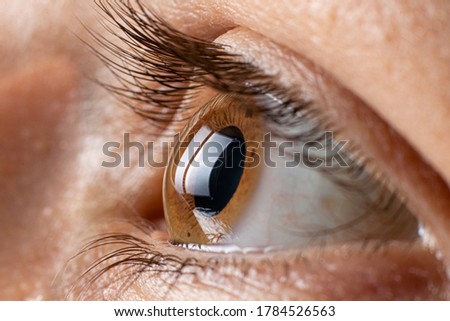 Keratoconus of eye, 3th degree. Contortion of the cornea in the form of a cone, deterioration of vision, astigmatism. Macro close up. Royalty-Free Stock Photo #1784526563