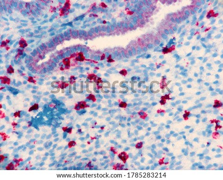 Section of endometrium with numerous natural Killer cells which have bright red expression of the marker, CD 56. Glands and stroma are light blue. Microscopic view.  Royalty-Free Stock Photo #1785283214