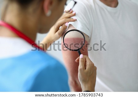 Doctor holds magnifying glass and determines degree of sunburn. First aid and treatment for burns concept Royalty-Free Stock Photo #1785903743