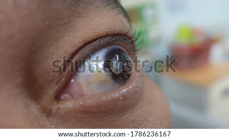 Mature Cataract seen in you d Adult secondary to Diabetes Mellitus.