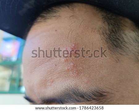 A picture of blisters on the face due to shingles.
