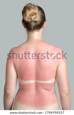 Sunburn. The red back of a woman after a sunburn. Royalty-Free Stock Photo #1786998107