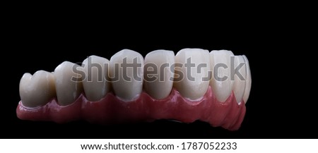 dental treatment by implants and press ceramic crowns