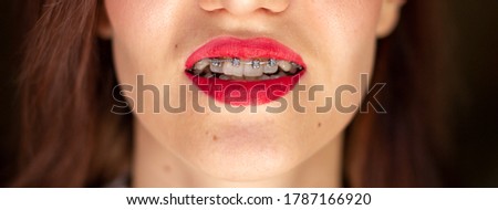 braces system in smiling mouth, macro photo teeth, close-up lips, macro shot.