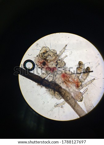 Pubic lice, also known as pubic lice, crab lice, crab fires, inguinal lice. These are pictures of them viewed through a microscope