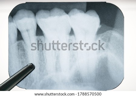 panoramic dental x-ray of a mouth.
