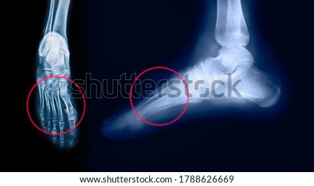 Foot pain on x-ray  isolated on black background