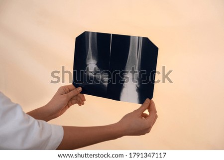Orthopedist examining X-ray picture on viewing screen, closeup
