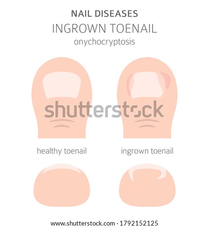 INGROWN-TOENAIL Stock Vector Images - Avopix.com