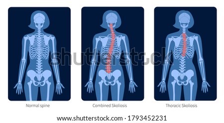 Normal spine and types of spine defects. Scoliosis in woman body. XRay flat vector illustration. Backbone, skeleton anatomy in female silhouette. Orthopedic poster. Medical exam in spinal pain center