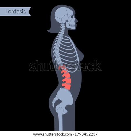 Lordosis in female body. Scoliosis XRay flat vector illustration. Spine, backbone, joint and skeleton anatomy in woman silhouette. Orthopedic poster. Medical banner. Exam in spinal pain center, clinic