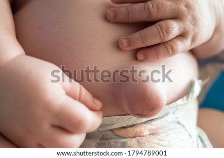 Umbilical hernia on a 8 week old baby boy   Royalty-Free Stock Photo #1794789001